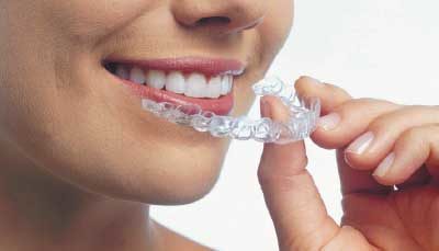 Free Invisalign